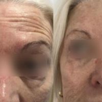 Arrugas del tercio superior facial