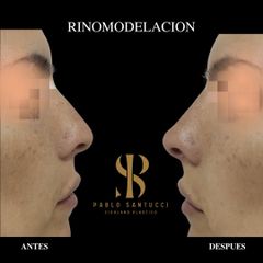 Rinomodelación  - Dr. Pablo Santucci