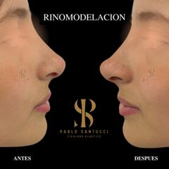 Rinomodelación  - Dr. Pablo Santucci