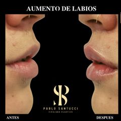Relleno de labios - Dr. Pablo Santucci