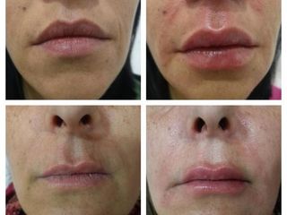 Relleno de labios