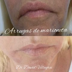 Arrugas de Marioneta - Dr. David Villagra