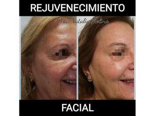 Rejuvenecimiento facial