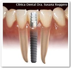 Implantes