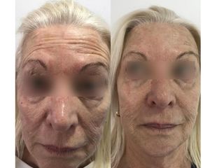 Botox 