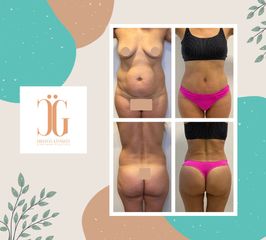 Liposucción - Dr. Cristian Gänsslen
