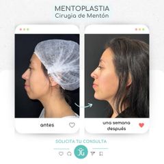 Mentoplastia - Dr. Cristian Gansslen
