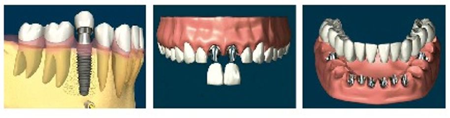 Implantes