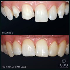 Carillas | Dr. Lucas Matías Clerici