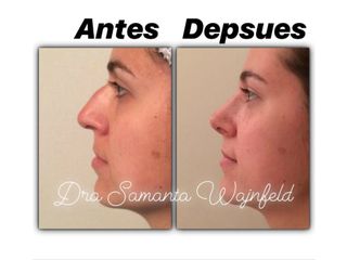rinoplastia -antes y despues- 