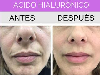 Acido Hialurónico