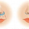 Lip Lift o Lifting de Labio en Argentina
