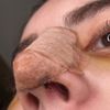 Se abrió la sutura de mi rinoplastia ?