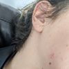 Verruga plana en rostro