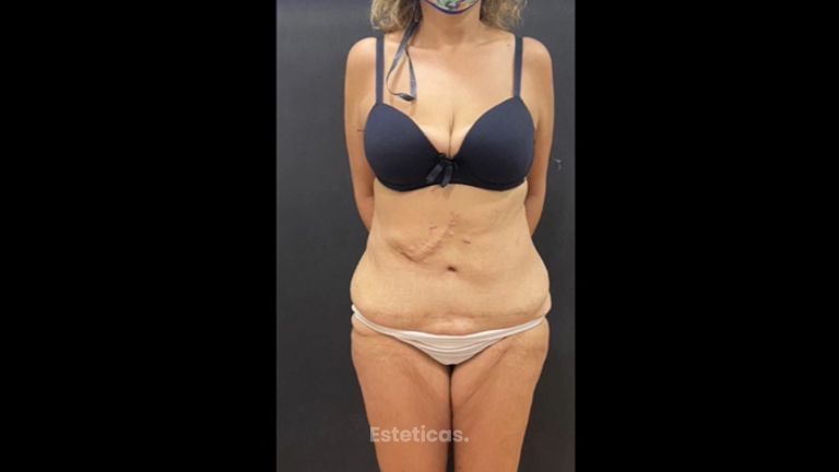 Abdominoplastia - Dr. Emmanuel Manavela Chiapero