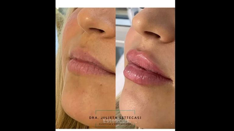 Relleno de labios - Dra. Julieta Settecasi