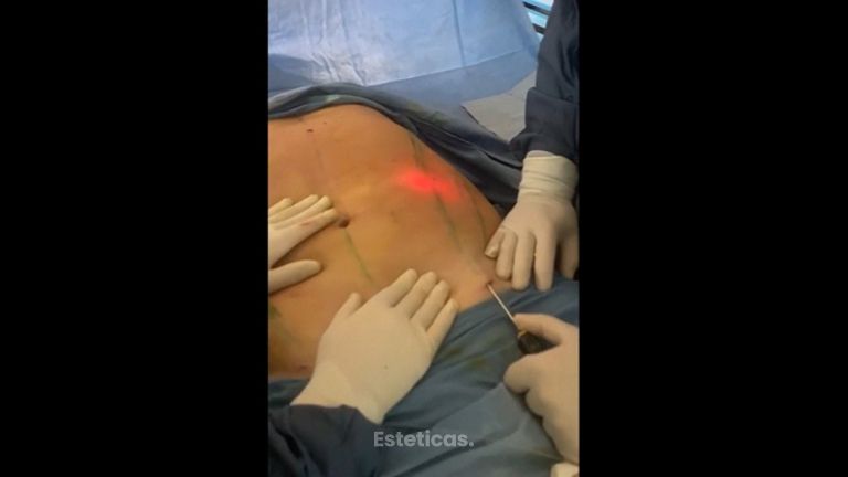 Liposucción 