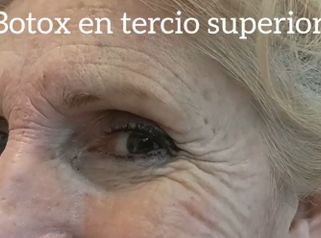 Toxina Botulínica - Dr. David Villagra