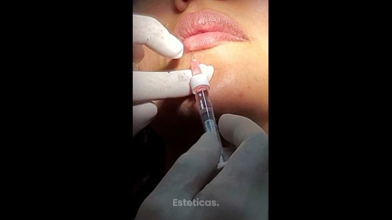 Relleno de labios - Dra. Cristina G. Lazarte