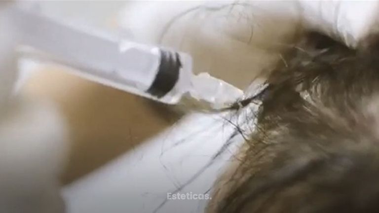 Mesoterapia Capilar
