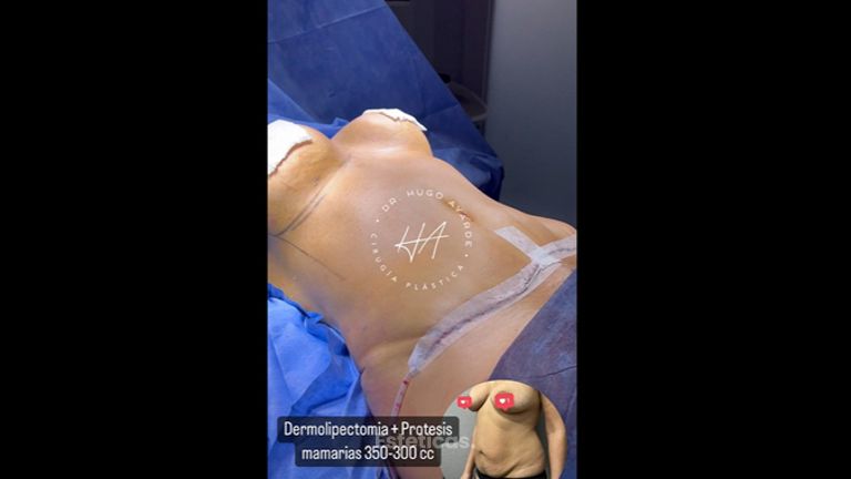 Dermolipectomía - Dr. Hugo Ayarde
