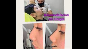 Cita de revisión para rinomodelación.