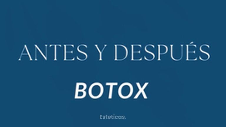 Botox - Estetica Casal