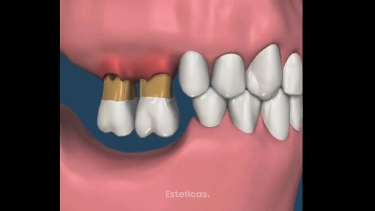 Implante dental - Dental Advance