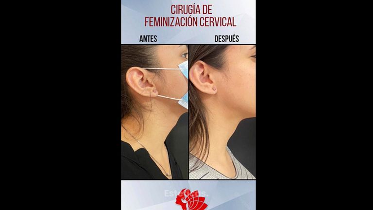 Feminización del rostro - Dr. Emmanuel Manavela Chiapero