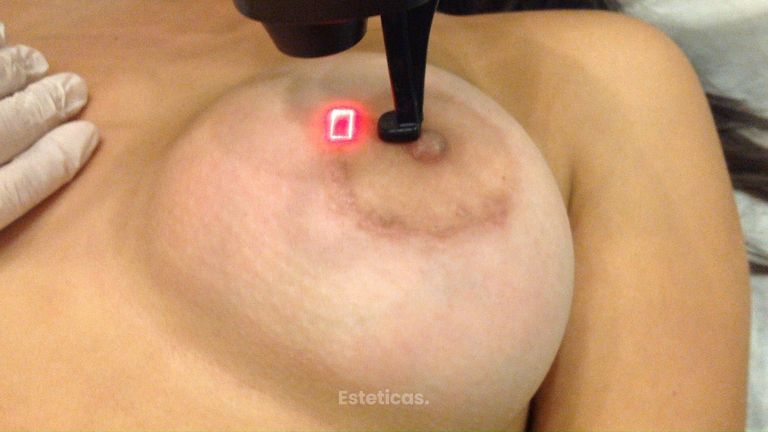 LASER CO2 para tratar cicatrices - Dra. Adriana Ratto