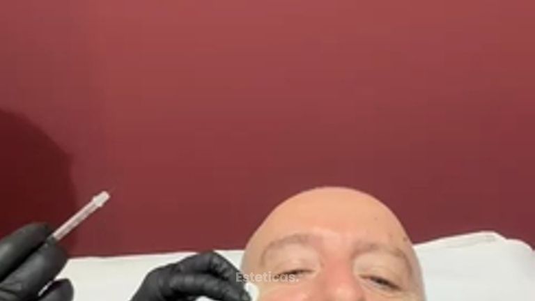 Botox - Dr. Victor Armesto
